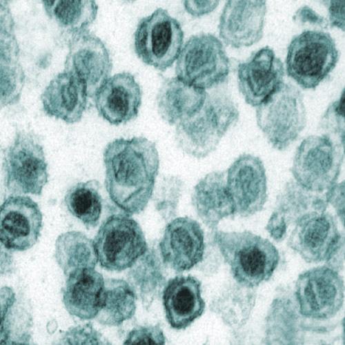 Un virus à l'origine du syndrome de fatigue chronique ?